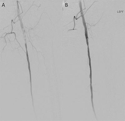 Successful Treatment of Acute Limb Ischemia Secondary to Iatrogenic Distal Embolization Using Catheter Directed Aspiration Thrombectomy